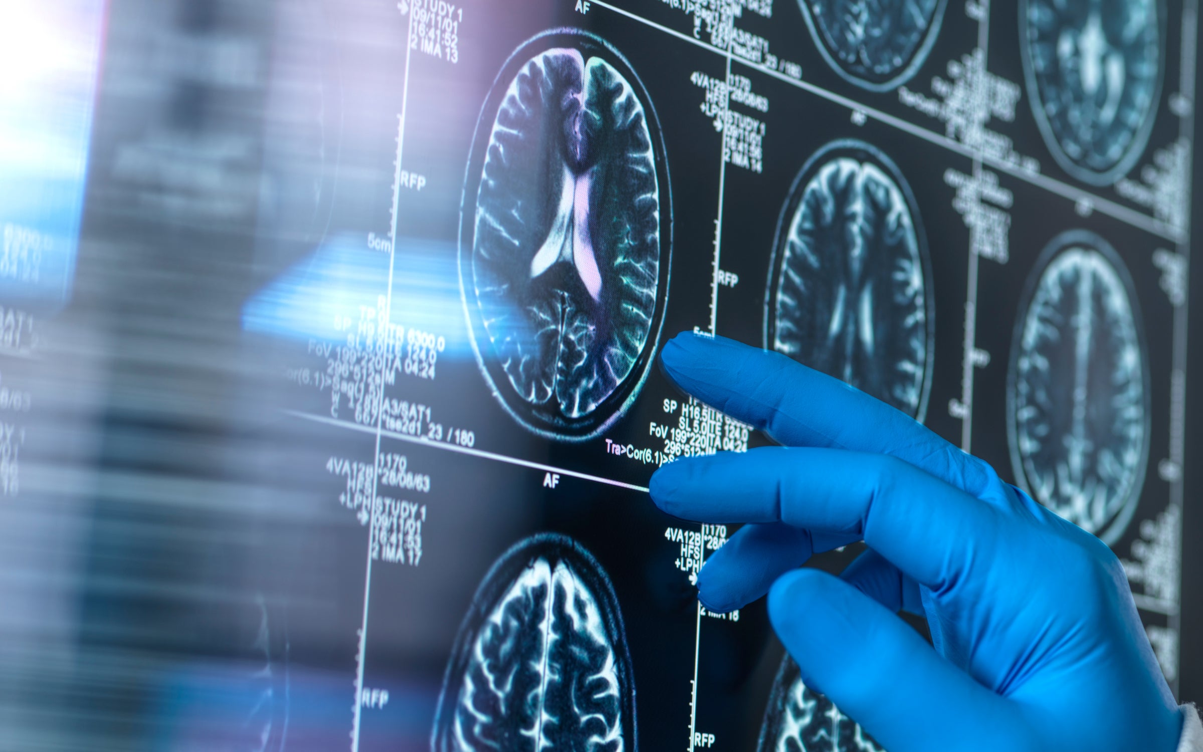 A scientist's gloved hand touching a screen with a patient's brain MRI scan for ageing and damage due to dementia and Alzheimer's disease.