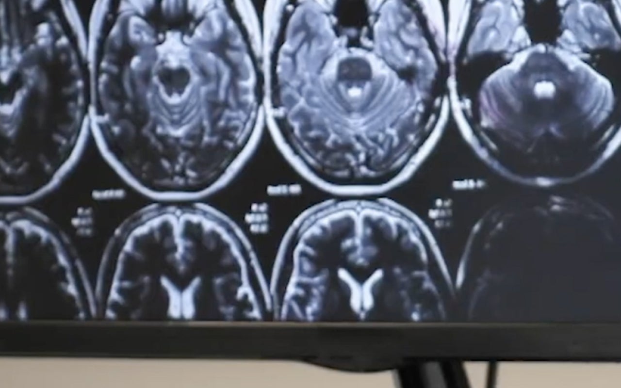 Cure Alzheimer's