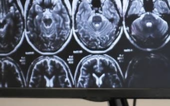 Cure Alzheimer's
